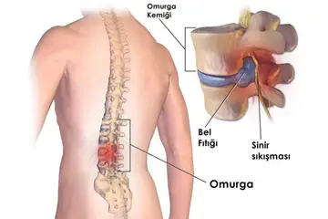 Bel Fıtığı Ameliyatı Sonrası Ağrılar?