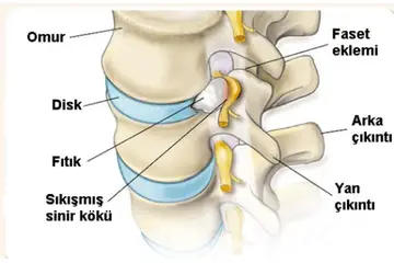Boyun Fıtığı Patlaması Belirtileri ve Tedavisi