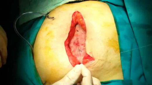 Açık Bel Fıtığı Ameliyatı Riskleri ve Sonrası