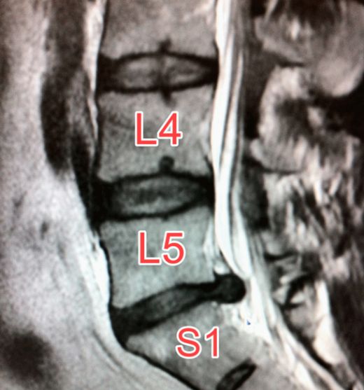 Bel Fıtığı Mr Kullanımı ve Faydaları Nelerdir?