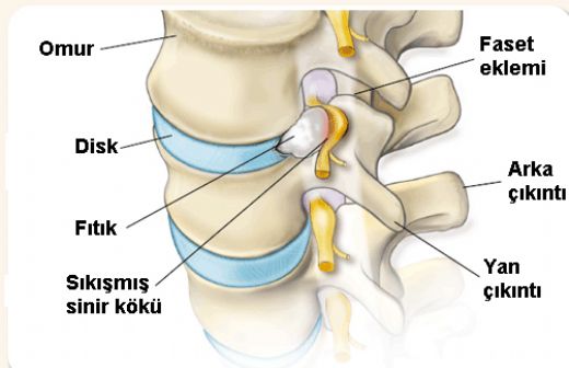 Bel Fıtığı Yırtılması Belirtileri ve Tedavisi
