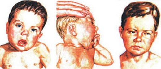 Boyun Eğriliği Belirtileri ve Tedavisi