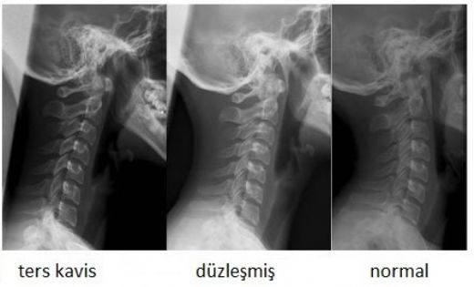 Boyun Fıtığı Başlangıcı Belirtileri ve Tedavisi