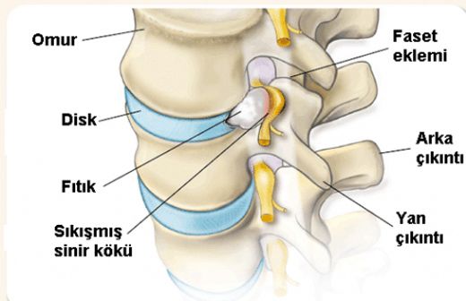 Boyun Fıtığı Patlaması Belirtileri ve Tedavisi