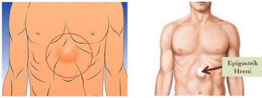 Epigastrik Fıtık Belirtileri ve Tedavisi