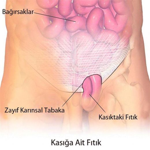 Erkeklerde Kasık Fıtığı Belirtileri ve Tedavisi