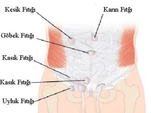 Fıtık Çeşitleri Nelerdir?