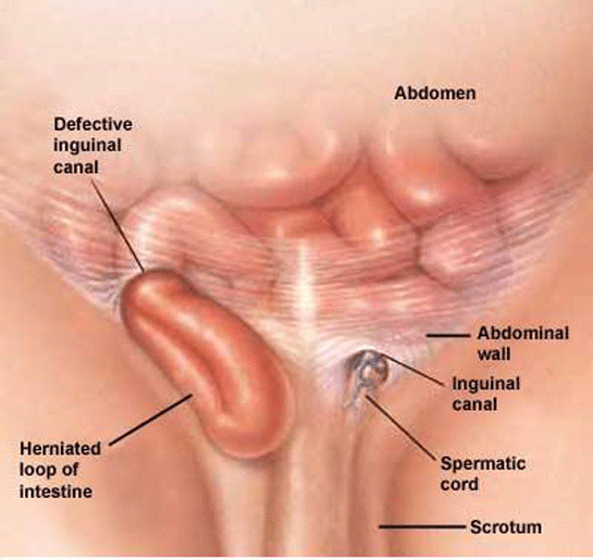 Bağırsak Fıtığı Belirtileri ve Tedavisi
