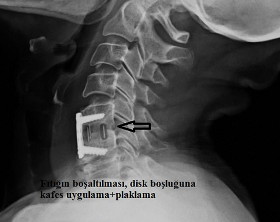 Boyun Fıtığı Ameliyatı Sonrası