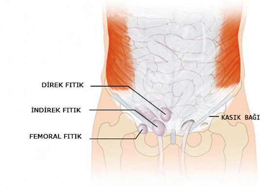 Femoral Fıtık Belirtileri ve Tedavisi